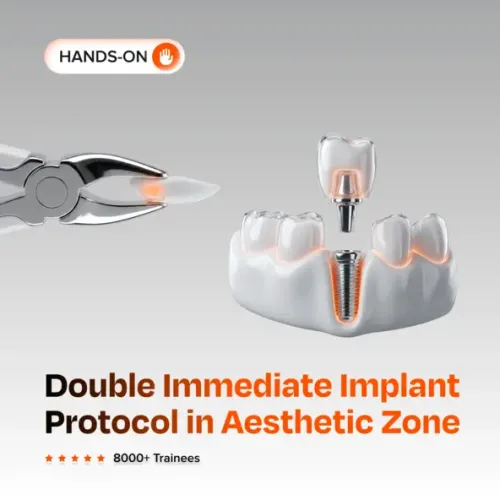 Double Immediate Implant Protocol in Aesthetic Zone