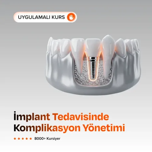 İmplant Tedavisinde Komplikasyon Yönetimi
